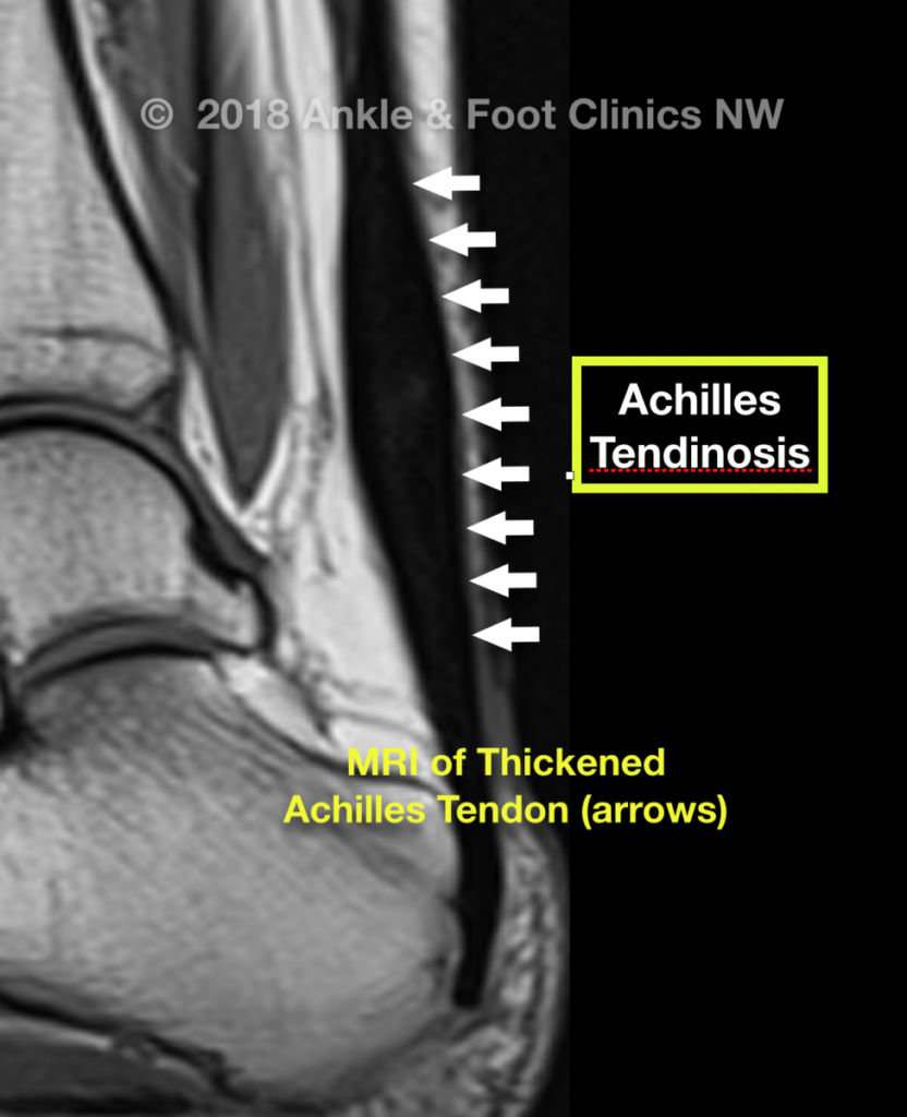 MRI of thickened Achilles tendon with arrows indicating Achilles Tendinosis