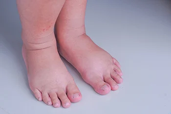 Close-up of two swollen feet and ankles showing visible puffiness