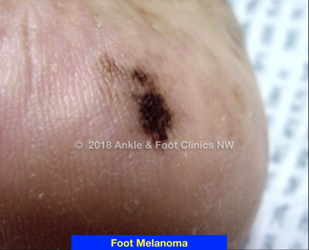 Close-up of a dark irregular melanoma lesion on a foot labeled Foot Melanoma