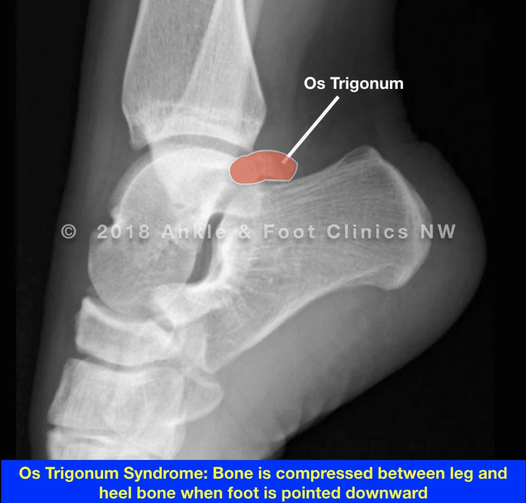 X-ray diagram labelling Os Trigonum bone location in the ankle
