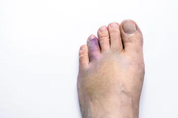 Top view of a foot with bruising and swelling near the toes