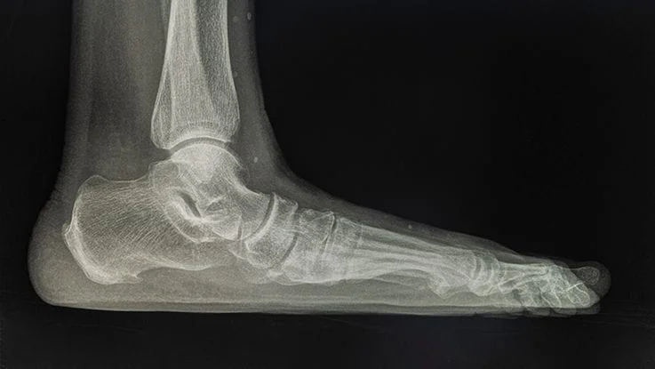 Person using an arch support orthotic for flat foot treatment