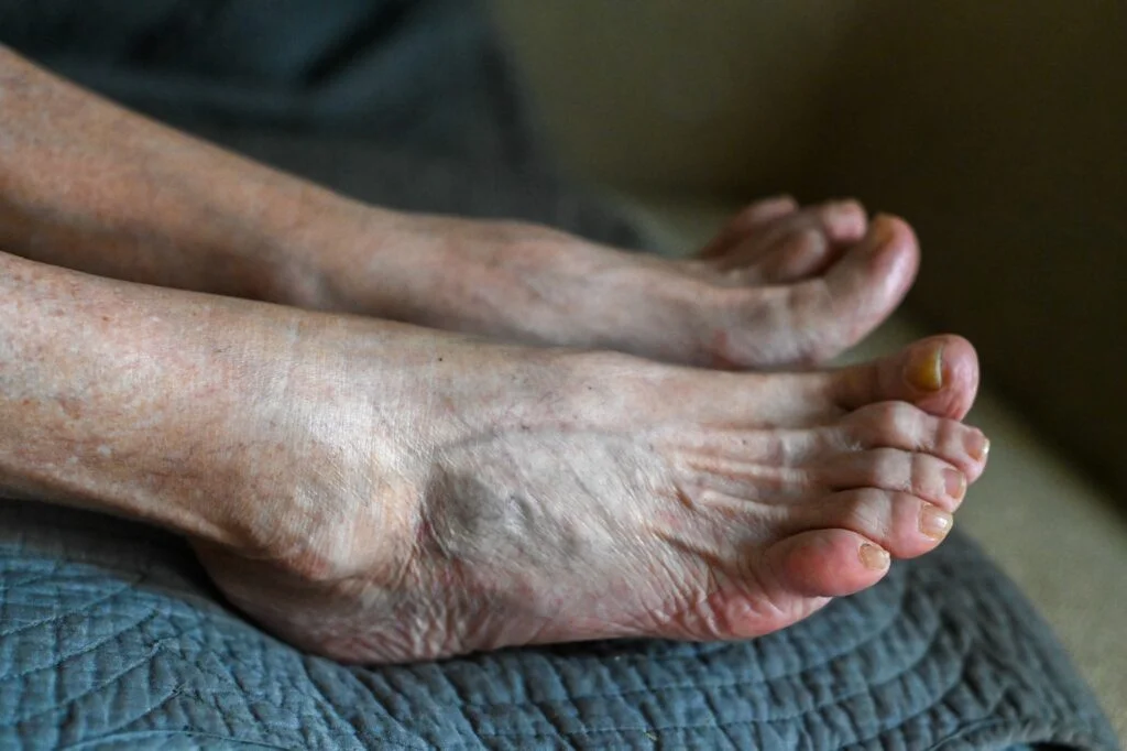 Feet showing joint changes and deformity associated with arthritis