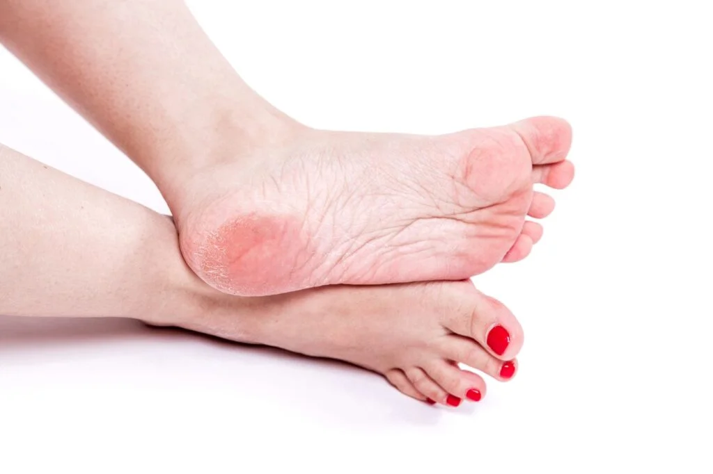Person using a foot file to remove dry skin from the heel.