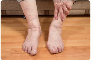 Close-up of swollen feet and ankles.