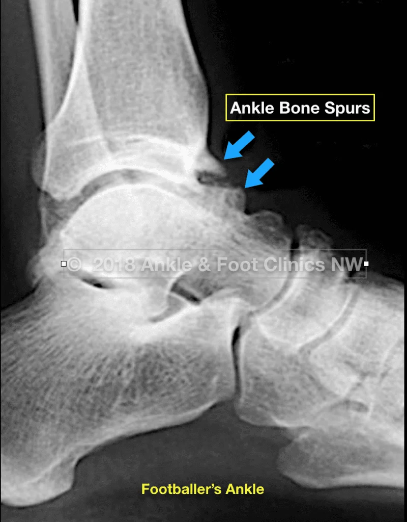 Footballers Ankle