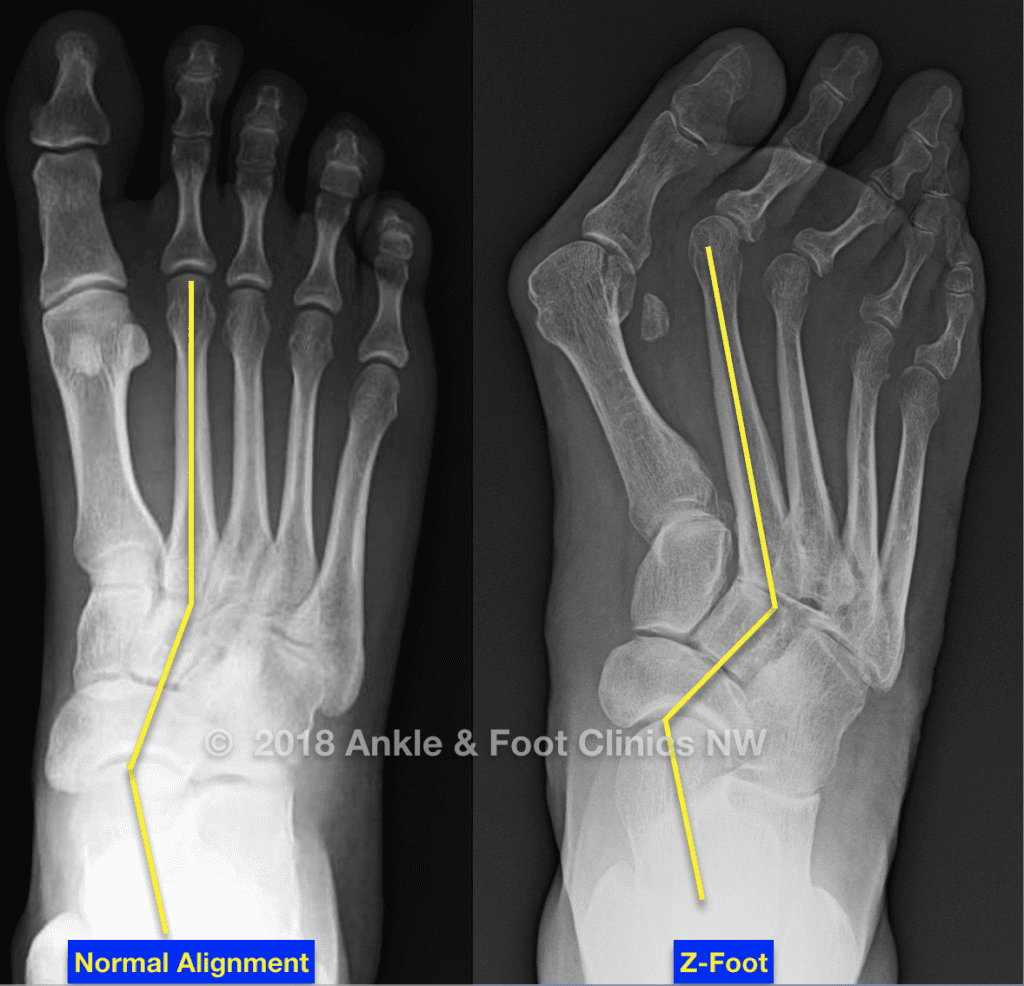 X-ray comparison of Normal Alignment foot and Z-Foot metatarsus adductus deformity