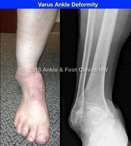 Varus ankle deformity shown in clinical photo and X-ray side by side