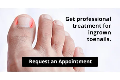 Ingrown toenail highlighted in red
