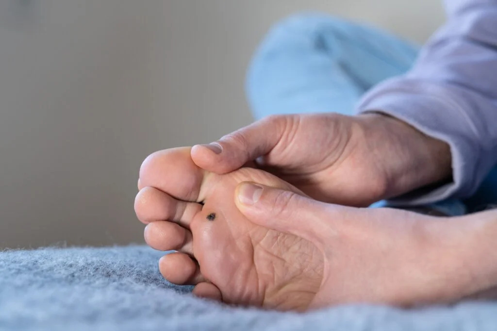 Healthcare professional performing treatment on a patient's foot.